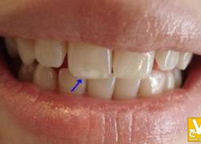 چطور می توان دندان های زیبا و سفید داشت؟